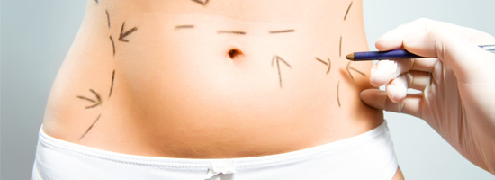 tummytuck